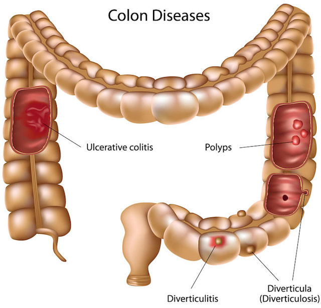 Cleanse Colon regularly