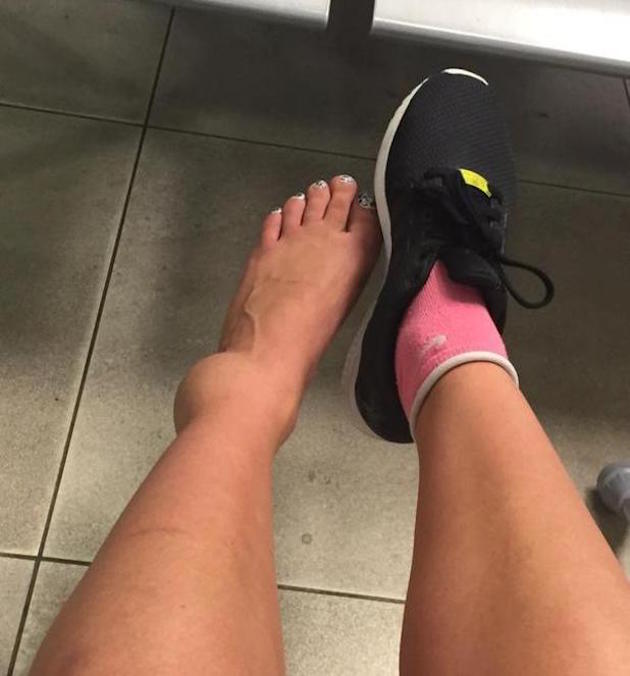 TOWIE's Ferne McCann shows off ankle injury on June 19, 2015