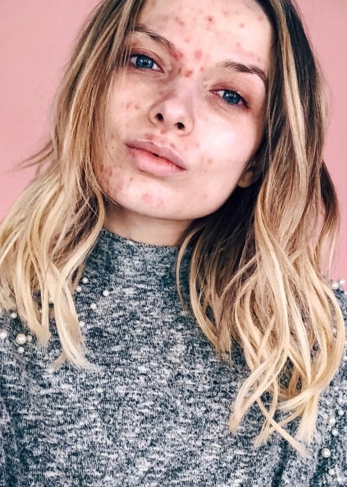 Em Ford confidently showing her acne in a selfie in January 2018