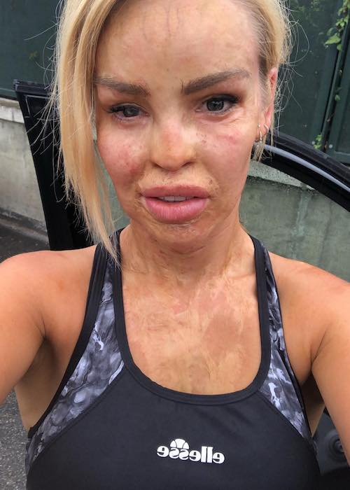 Katie Piper showing her acid affected face after a morning running session in August 2018