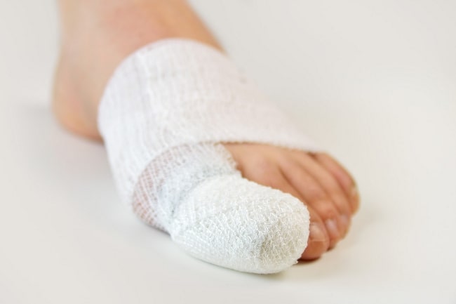 A foot in bandages after bunion removal surgery